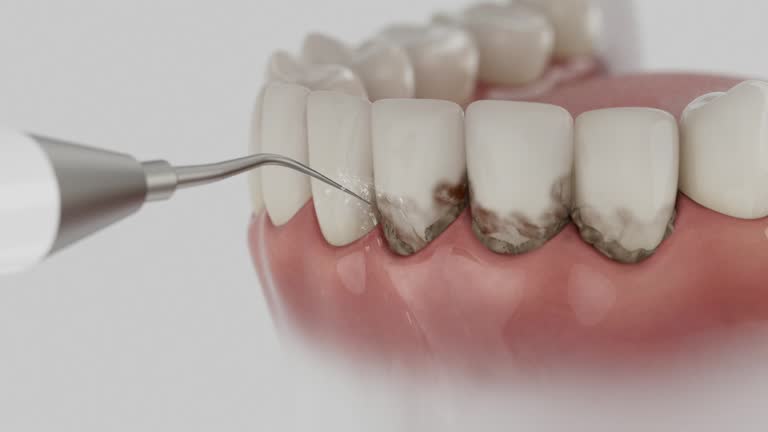 Reliable Tooth Extraction contractor in Des Moines, IA by Smile Center Dentistry